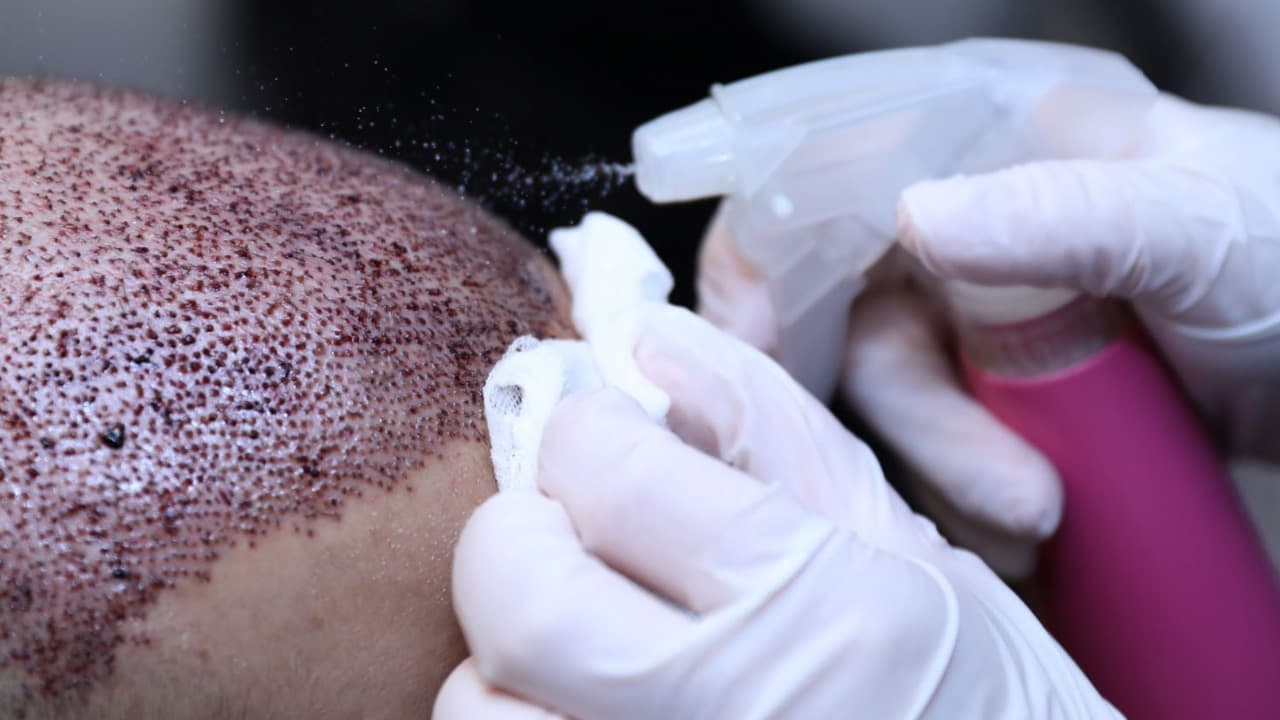 Hair Transplant London: Transformative Results by Skilled Surgeons